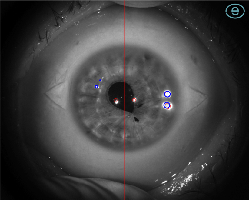 Infrared capture of an eye with tracking crosshairs and alignment markers