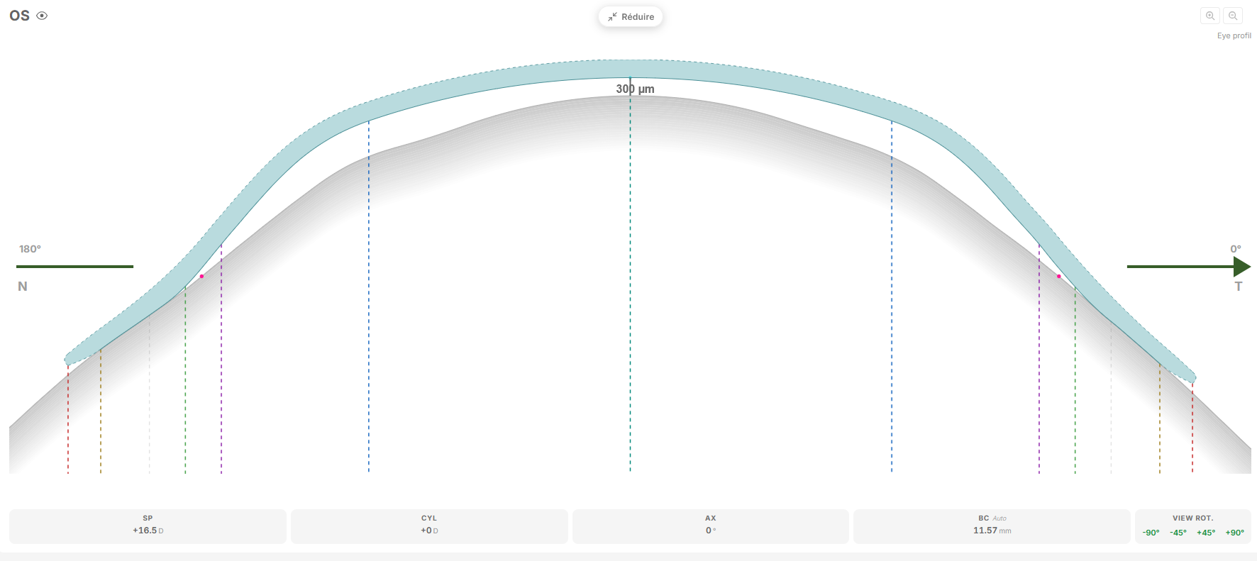 Sagittal section view of the designed lens over the eye profile with clearance readout