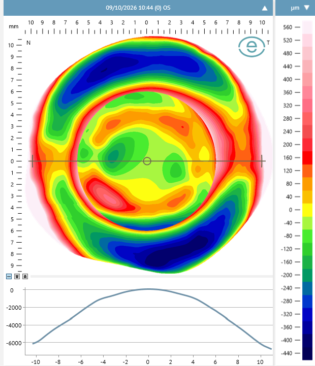 Bisphere elevation map of the eye with cross-section profile and micrometre scale